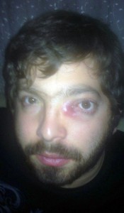 Gözündeki Şişlik Hayatını Kararttı