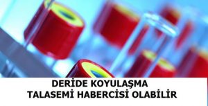 DERİDE KOYULAŞMA TALASEMİ HABERCİSİ OLABİLİR