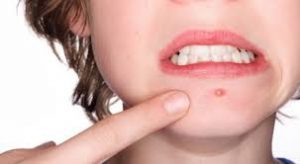 AKNEYE YOL AÇAN 10 ÖNEMLİ NEDEN